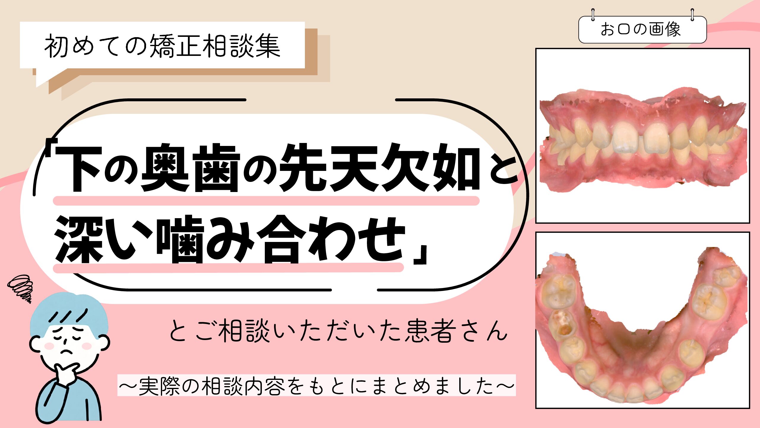 「下の奥歯の先天欠如と深い噛み合わせ」でご相談いただいたS.Sくん（12歳男の子）のケース