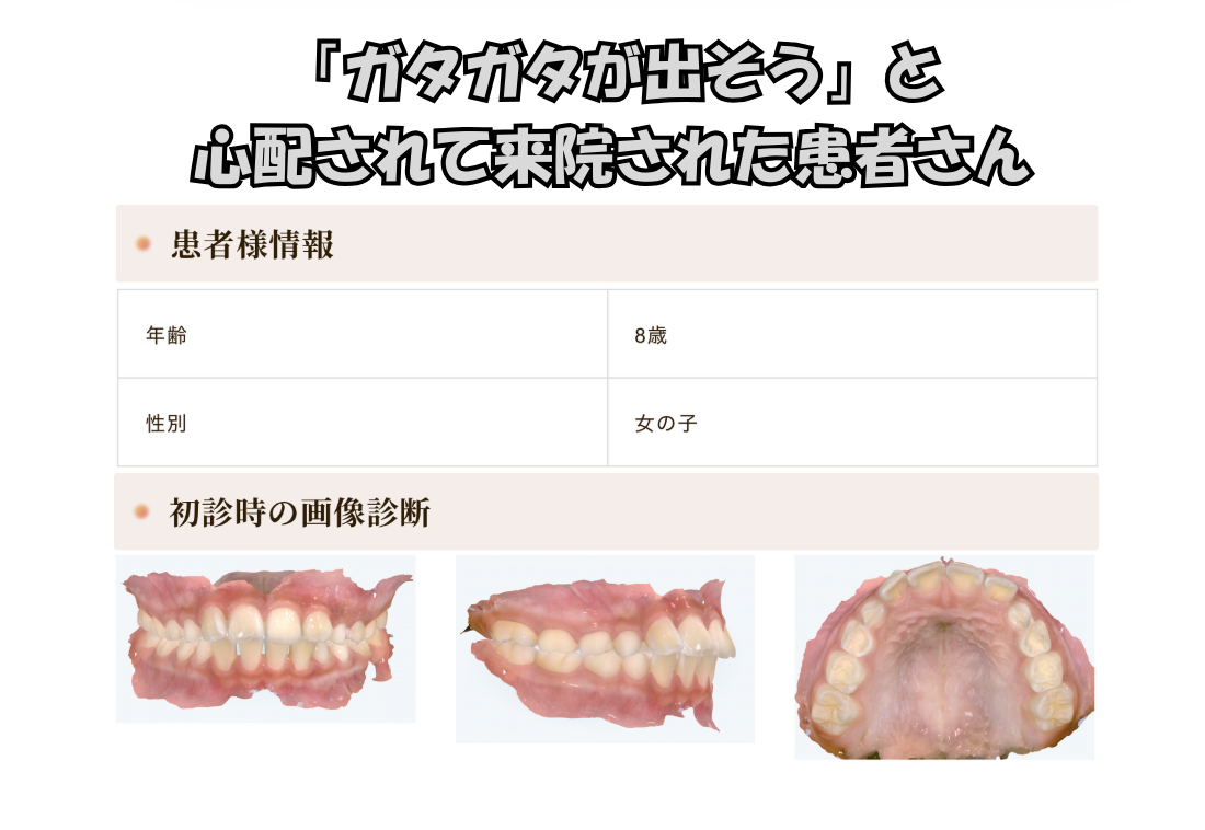 「ガタガタが出そう」と心配されて来院されたO.Mさん（8歳女の子）のケース