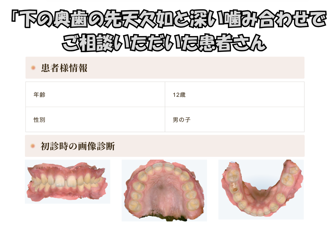 「下の奥歯の先天欠如と深い噛み合わせ」でご相談いただいたS.Sくん（12歳男の子）のケース