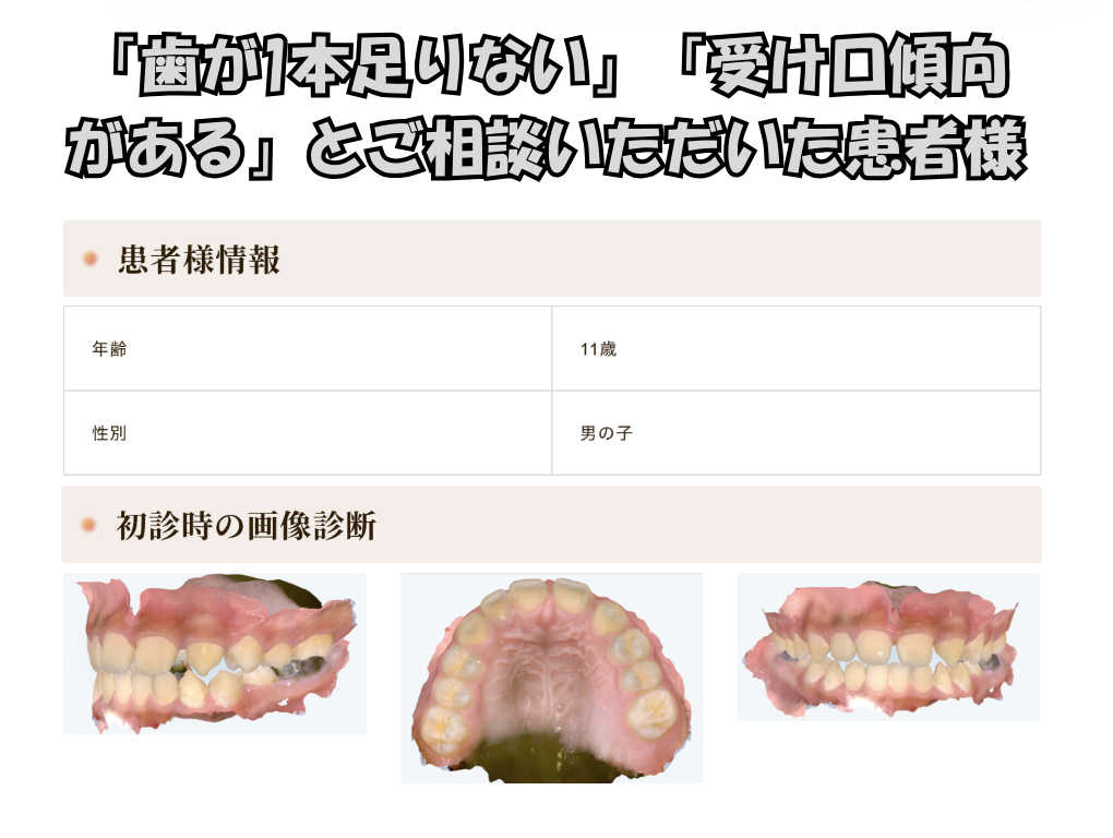 「歯が1本足りない」「受け口傾向がある」とご相談いただいたH.Kくん（11歳男の子）のケース