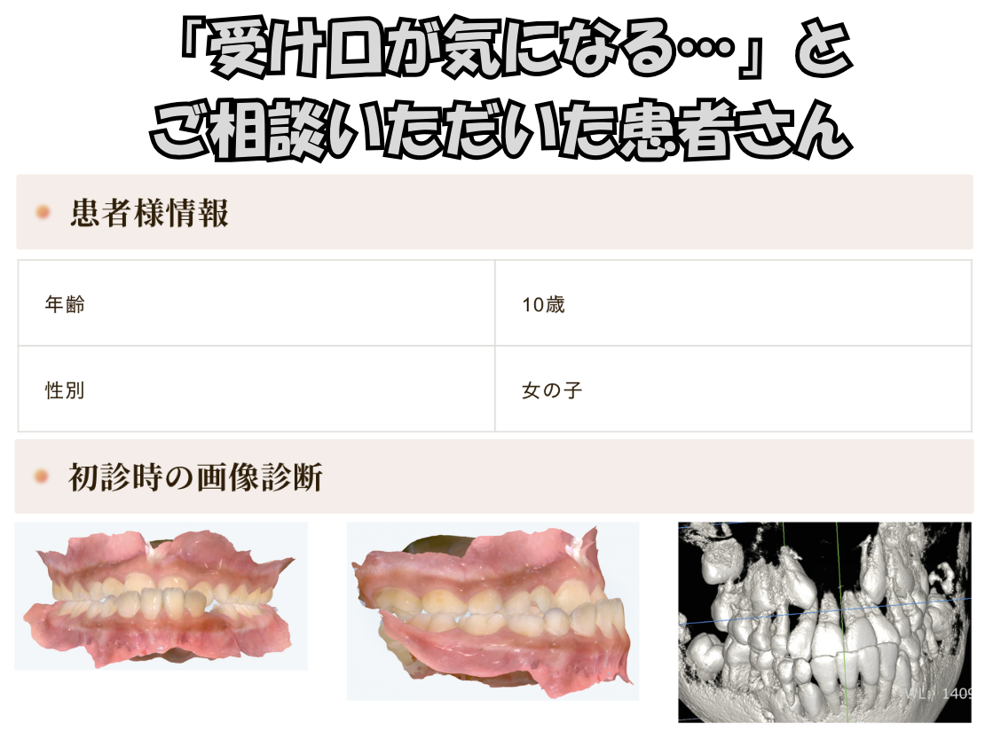 「受け口が気になる…」とご相談いただいたY.Tさん（10歳女の子）のケース