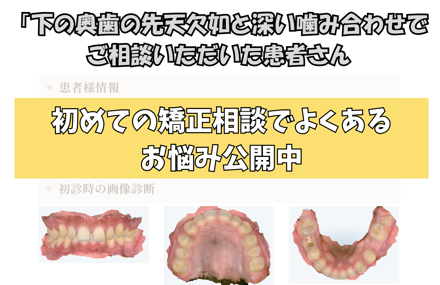 「下の奥歯の先天欠如と深い噛み合わせ」でご相談いただいたS.Sくん（12歳男の子）のケース