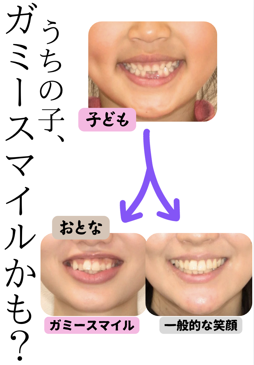うちの子、ガミースマイルかも？原因・治療法・子どものガミースマイルの考え方まで徹底解説します