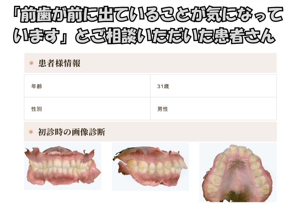 「前歯が前に出ていることが気になっています」とご相談いただいたT.Tさん（31歳・男性）のケース