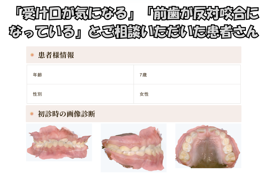 「受け口が気になる」「前歯が反対咬合になっている」とご相談いただいたK.Sさん（7歳女の子）のケース