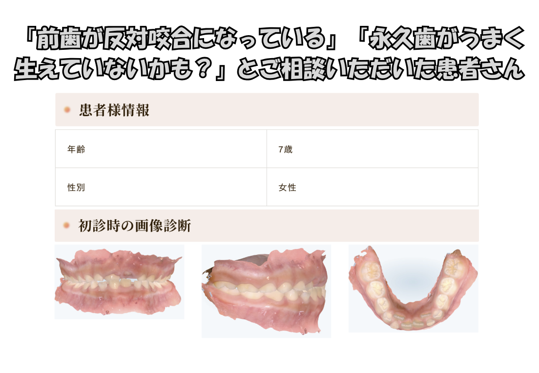 「前歯が反対咬合になっている」「永久歯がうまく生えていないかも？」とご相談いただいたM.Kさん（7歳・女の子）のケース