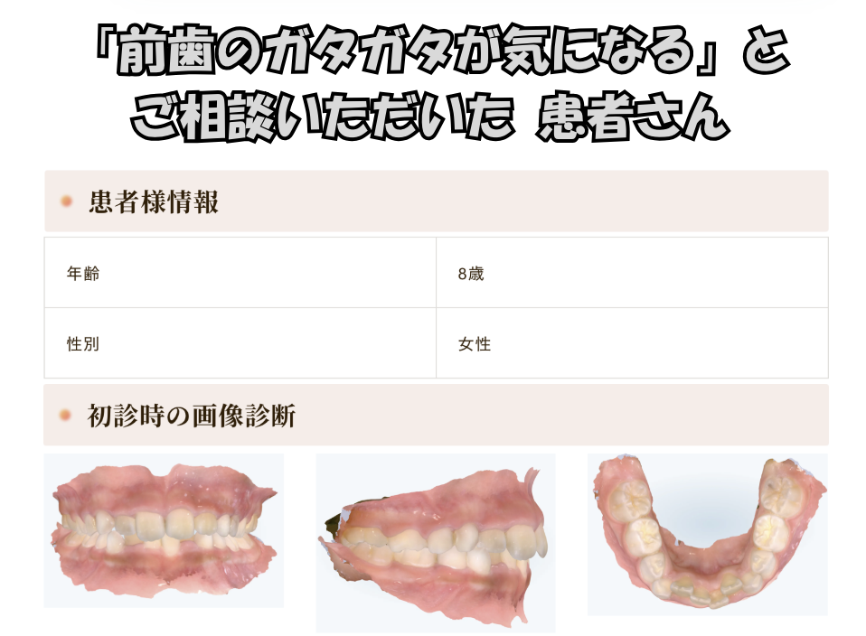 「前歯のガタガタが気になる」とご相談いただいた T.Kさん（8歳・女の子）のケース