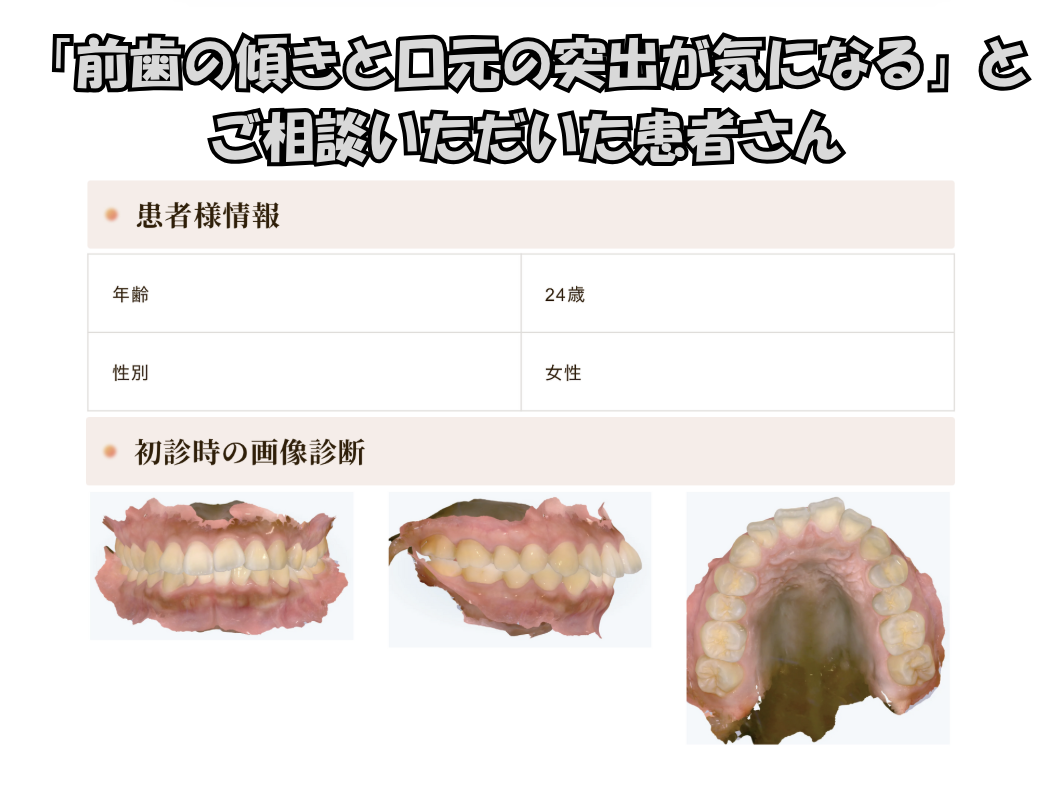 「前歯の傾きと口元の突出が気になる」とご相談いただいたN.Rさん（24歳・女性）のケース