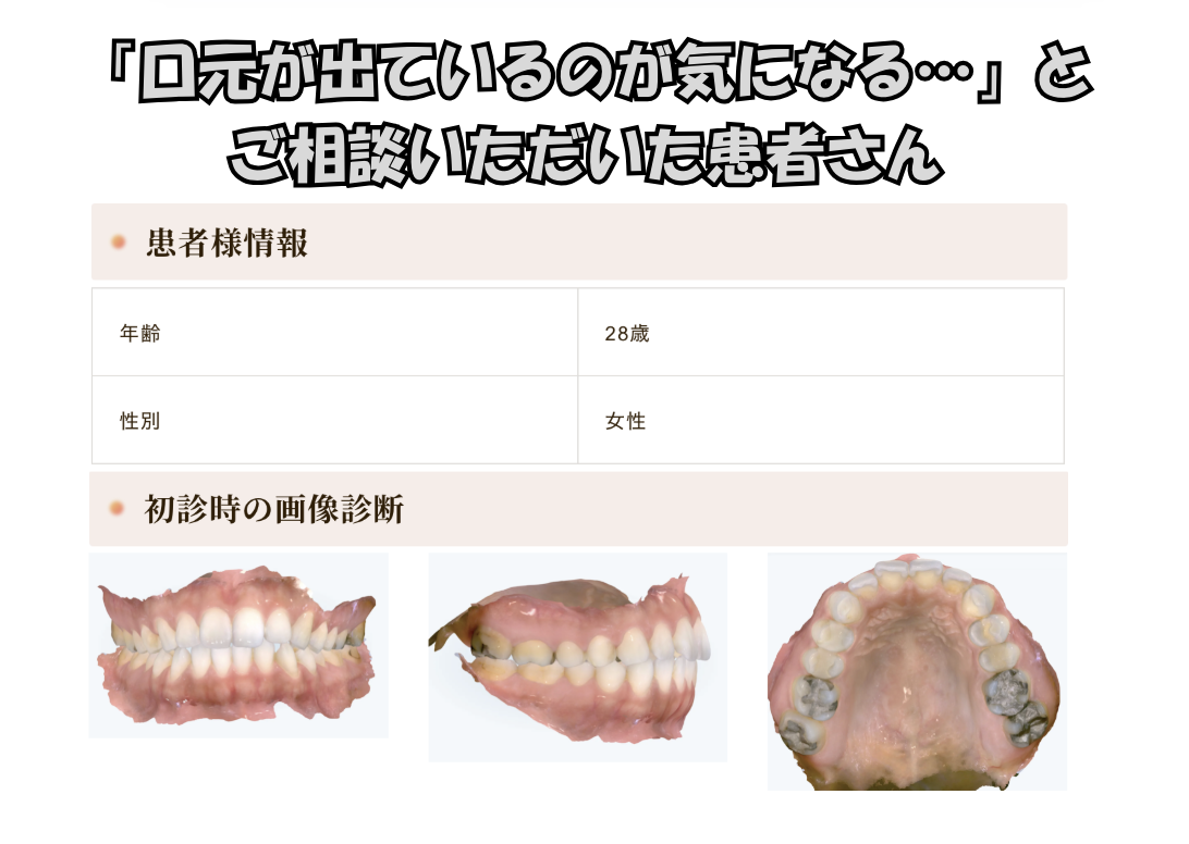 「口元が出ているのが気になる…」とご相談いただいたK.Mさん（28歳・女性）のケース