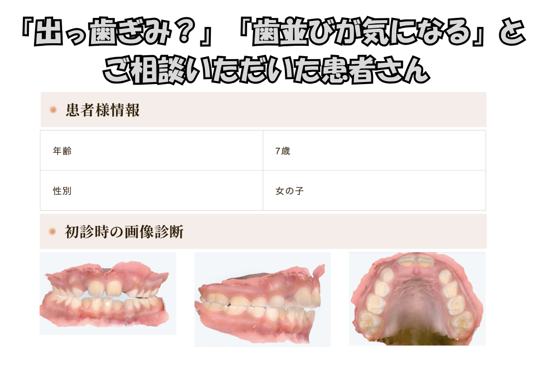 「出っ歯ぎみ？」「歯並びが気になる」とご相談いただいたN.Mさん（7歳・女の子）のケース
