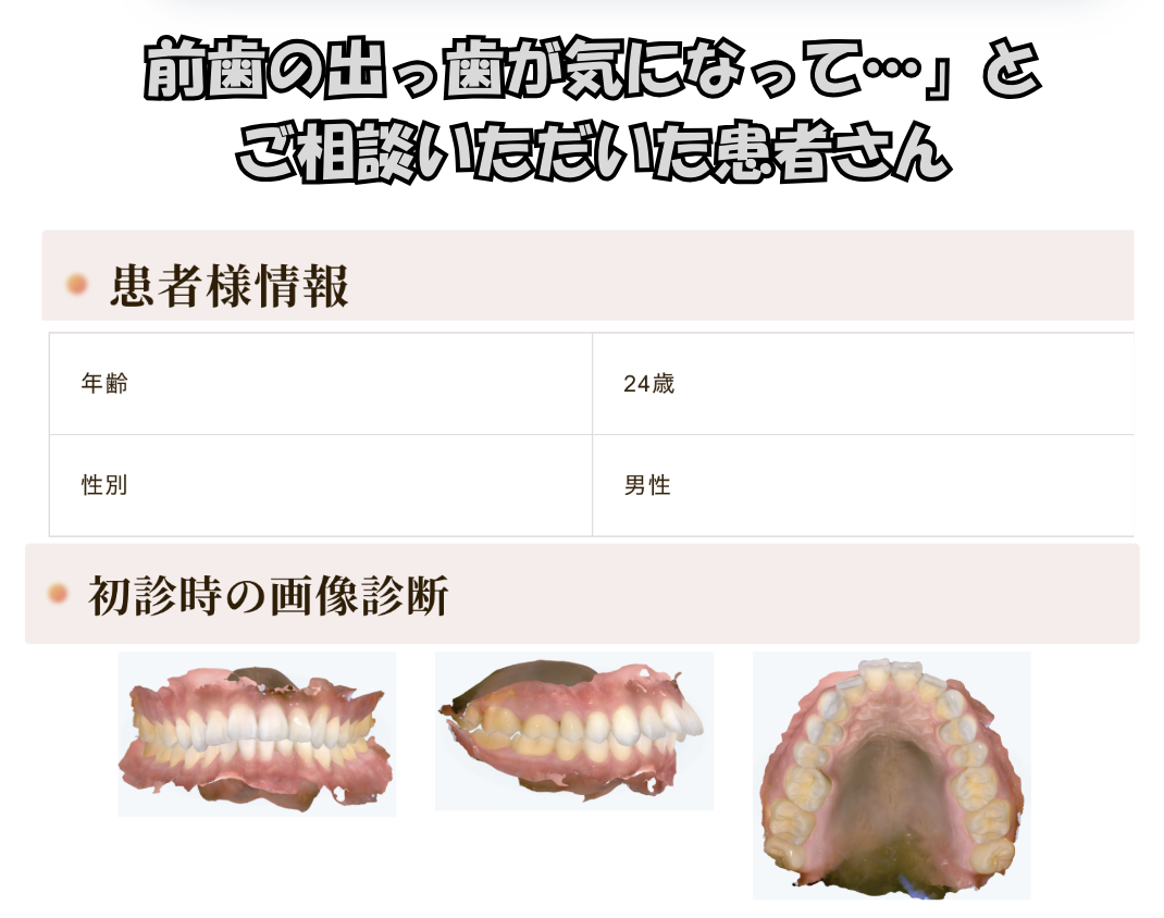 「前歯の出っ歯が気になって…」とご相談いただいたS.Rさん（24歳・男性）のケース