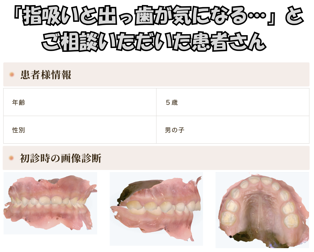 「指吸いと出っ歯が気になる…」とご相談いただいたH.Sさん（5歳・男の子）のケース