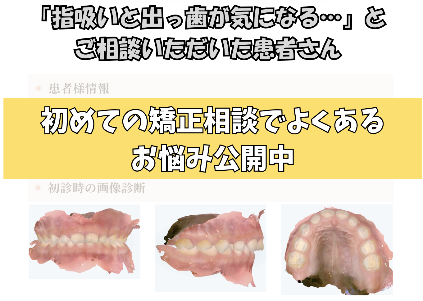 「指吸いと出っ歯が気になる…」とご相談いただいたH.Sさん（5歳・男の子）のケース