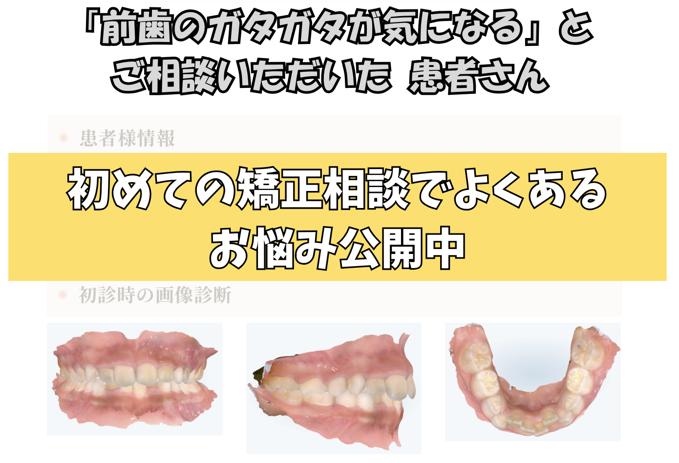 「前歯のガタガタが気になる」とご相談いただいた T.Kさん（8歳・女の子）のケース
