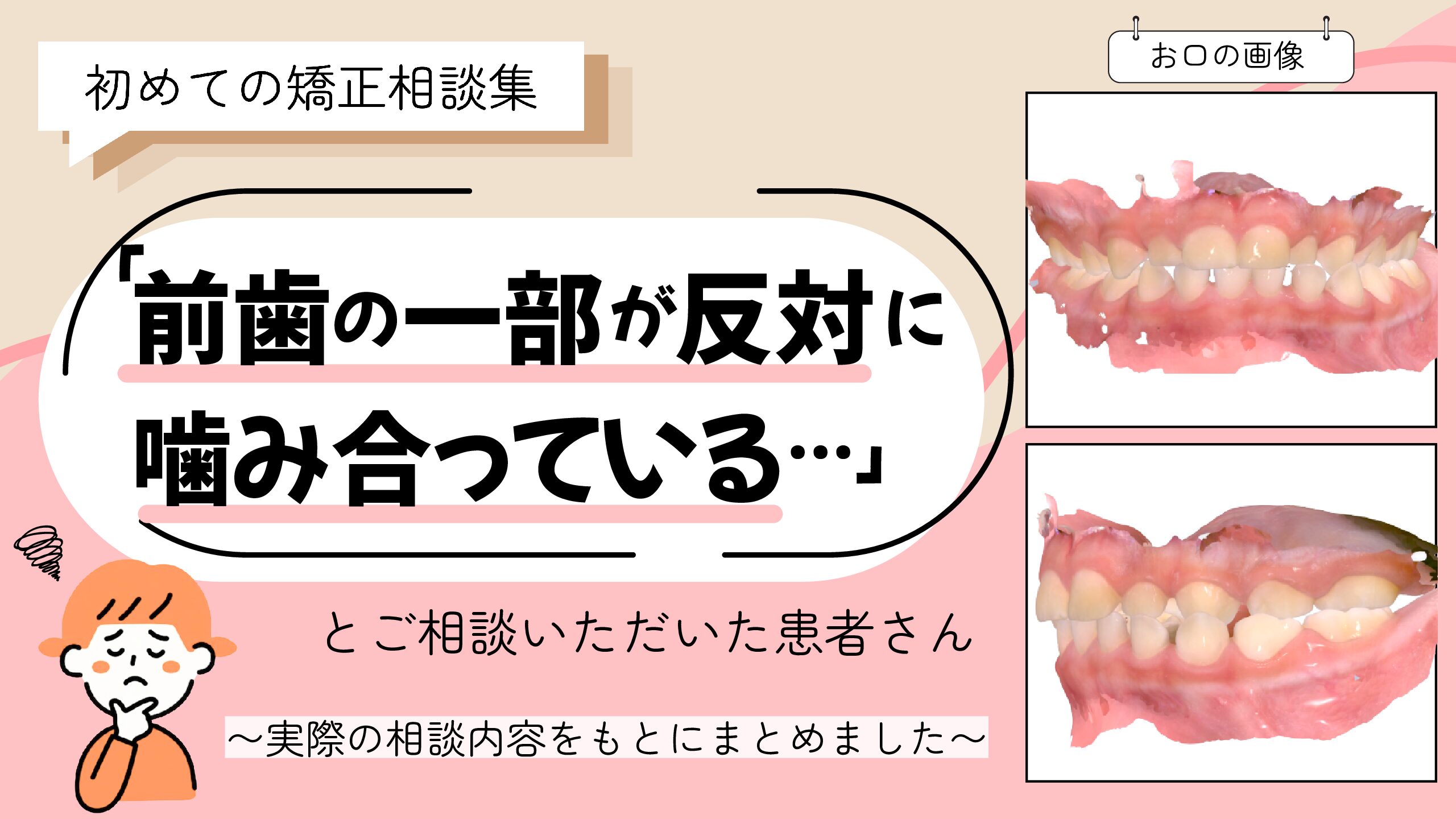 「前歯の一部が反対に噛み合っている…」とご相談いただいたK.Hさん（４歳・女の子）のケース