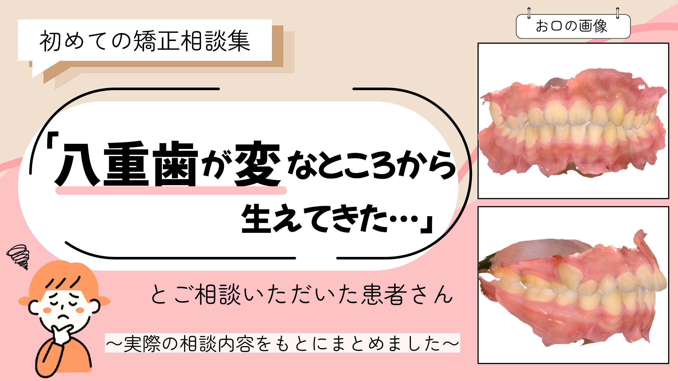 「八重歯が変なところから生えてきた…」とご相談いただいたK.Mさん（14歳・女の子）のケース