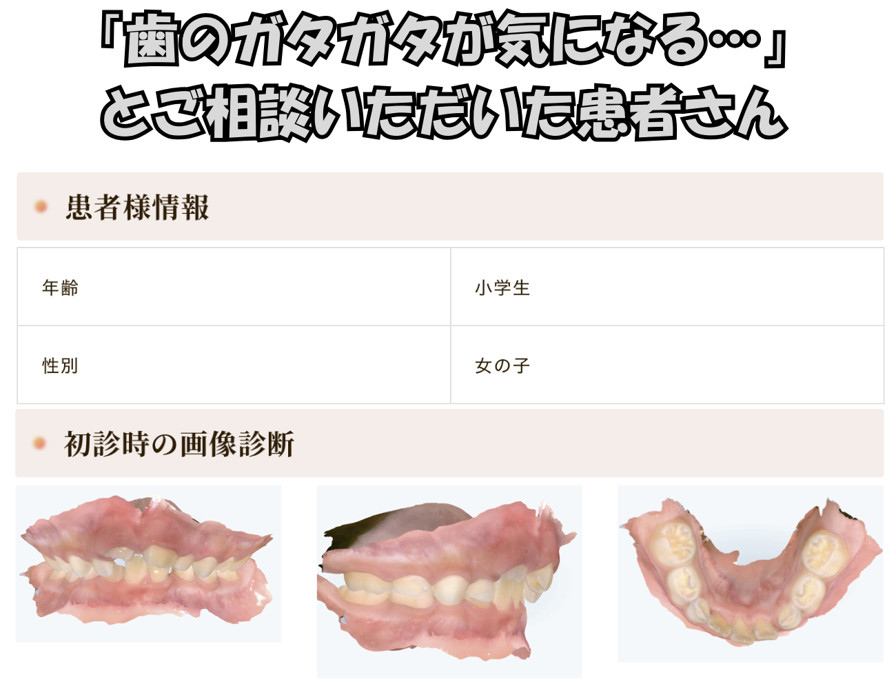 「歯のガタガタが気になる…」とご相談いただいた患者様のケース