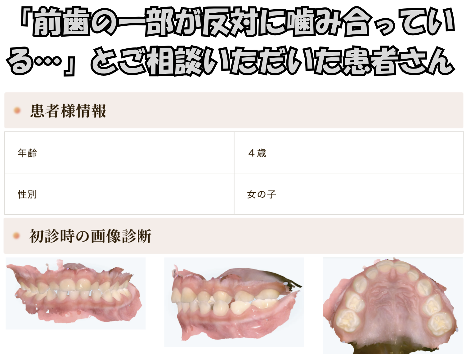 「前歯の一部が反対に噛み合っている…」とご相談いただいたK.Hさん（４歳・女の子）のケース
