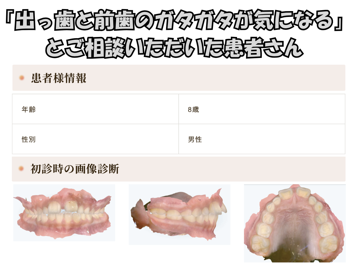「出っ歯と前歯のガタガタが気になる」とご相談いただいた K.Kさん（8歳・男の子）のケース