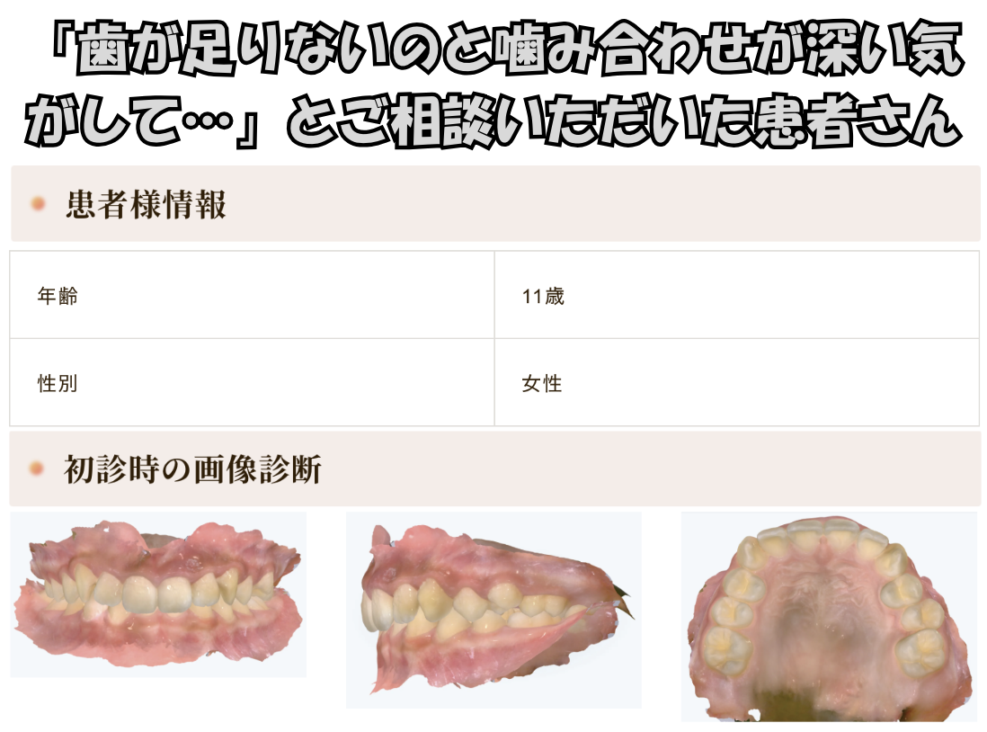 「歯が足りないのと噛み合わせが深い気がして…」とご相談いただいたT.Mさん（11歳・女の子）のケース
