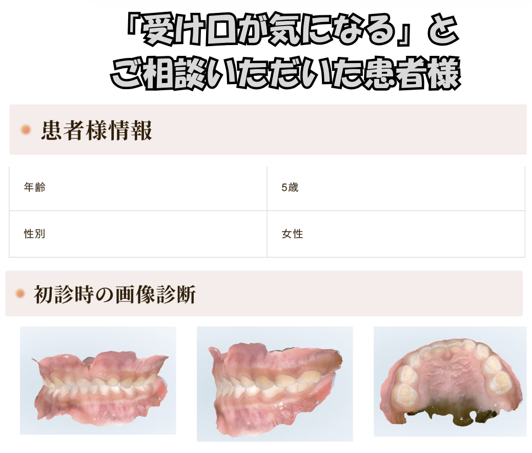 「受け口が気になる」とご相談いただいたI.Hさん（5歳・女の子）のケース