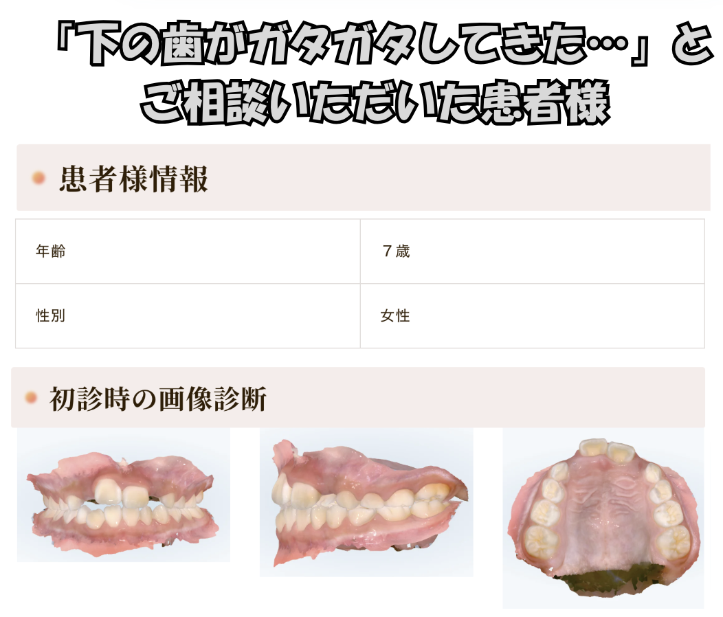 「下の歯がガタガタしてきた…」とご相談いただいたH.Kさん（7歳・女の子）のケース
