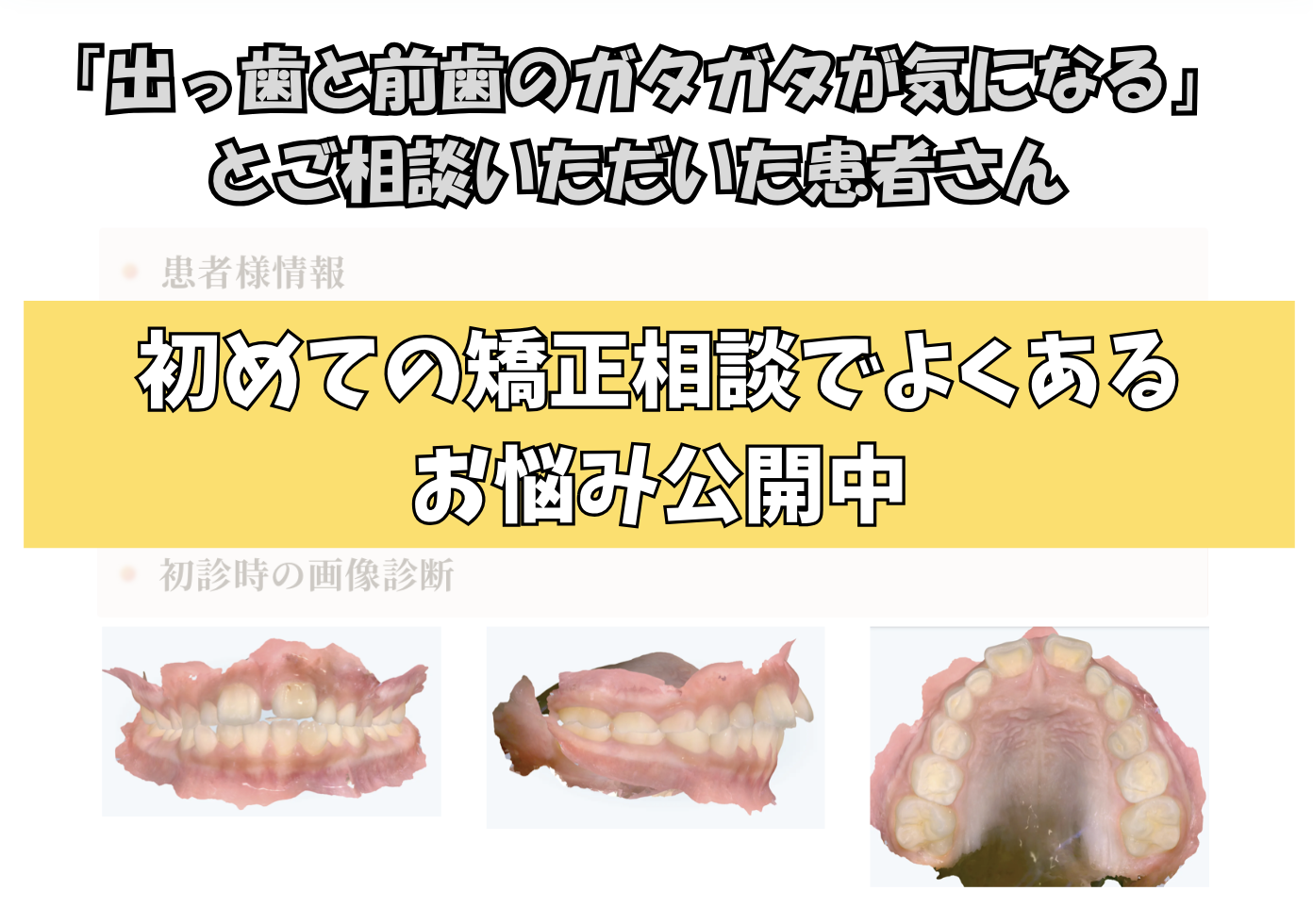 「出っ歯と前歯のガタガタが気になる」とご相談いただいた K.Kさん（8歳・男の子）のケース