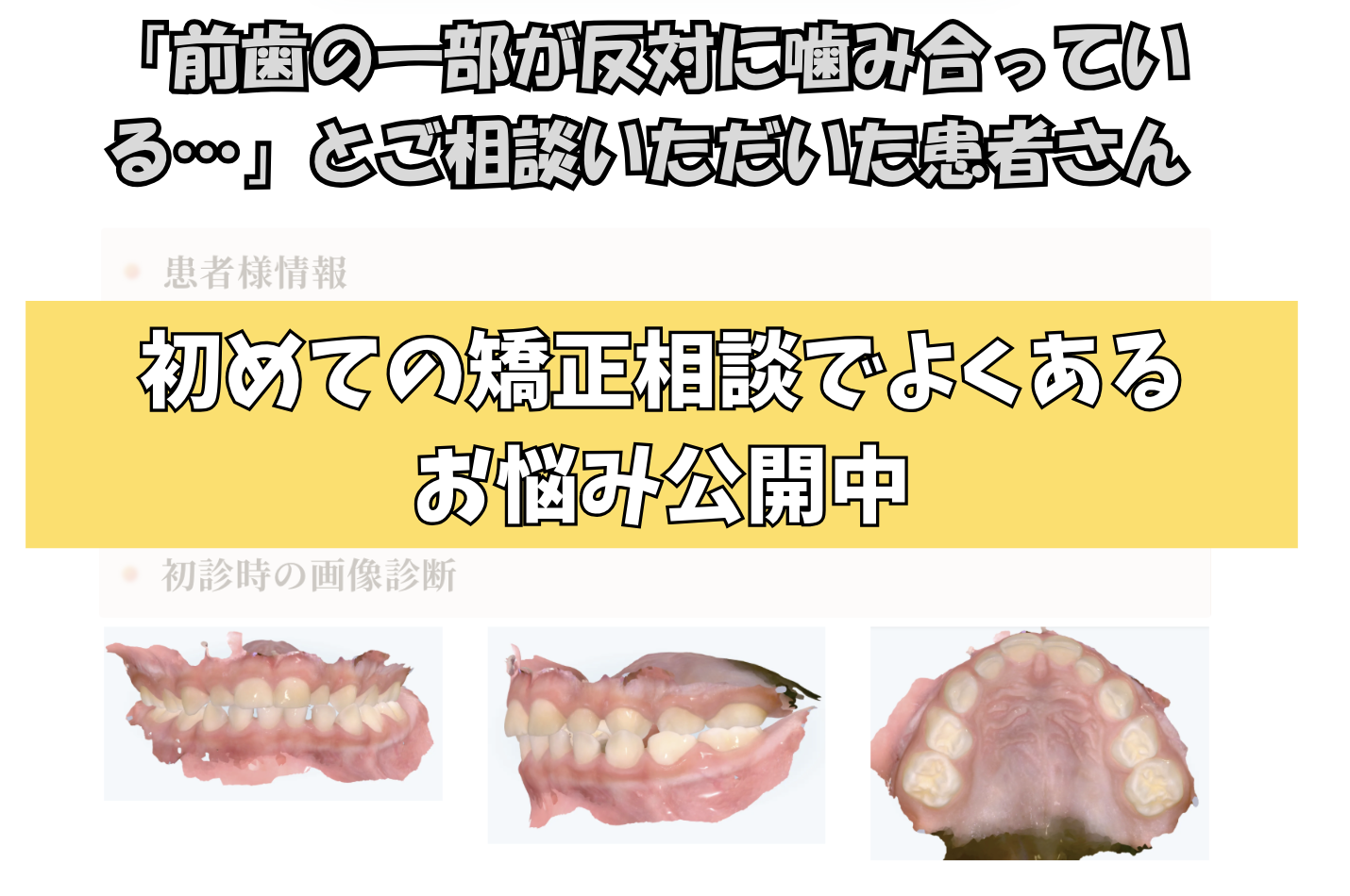 「前歯の一部が反対に噛み合っている…」とご相談いただいたK.Hさん（４歳・女の子）のケース