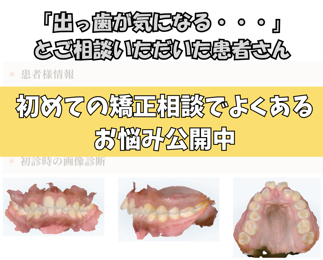 「出っ歯が気になる・・・」とご相談いただいた F.Tさん（11歳・女の子）のケース