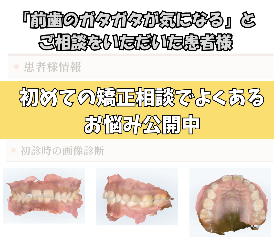 「前歯のガタガタが気になる」とご相談いただいた Mさん（7歳・女の子）のケース