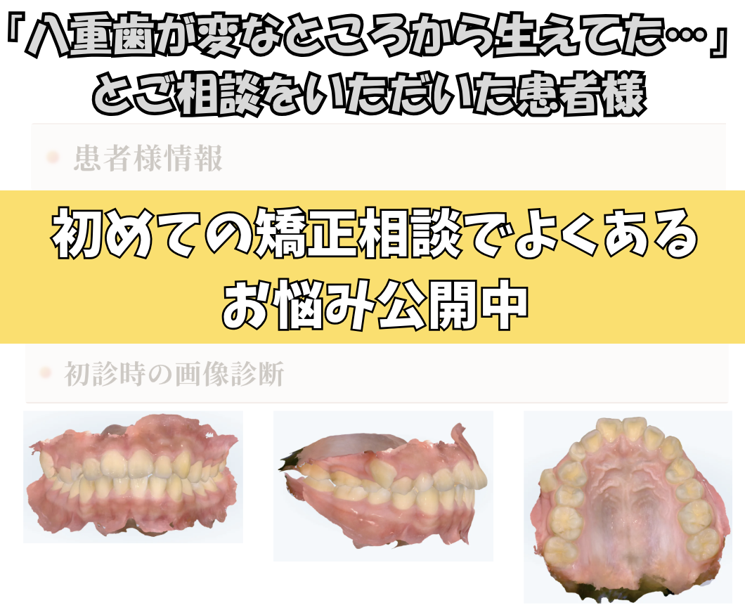 「八重歯が変なところから生えてきた…」とご相談いただいたK.Mさん（14歳・女の子）のケース