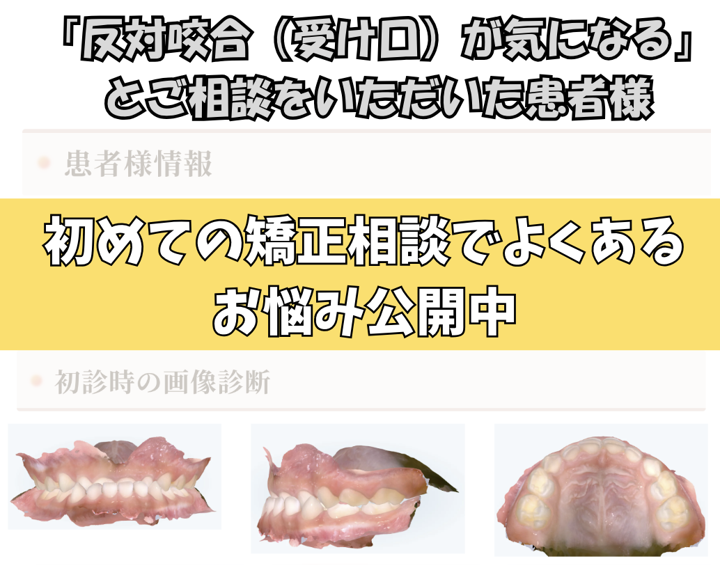 「反対咬合（受け口）が気になる」ご相談をいただいたT.Kさん（４歳・男の子）のケース