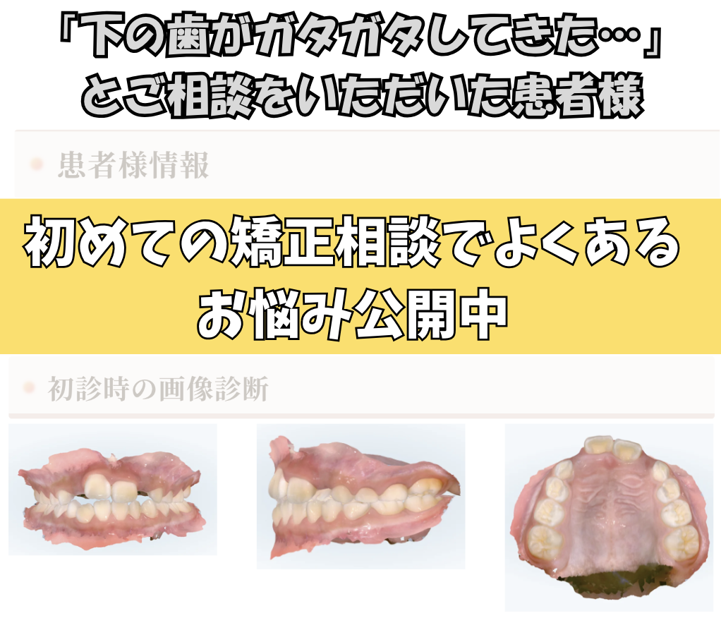 「下の歯がガタガタしてきた…」とご相談いただいたH.Kさん（7歳・女の子）のケース