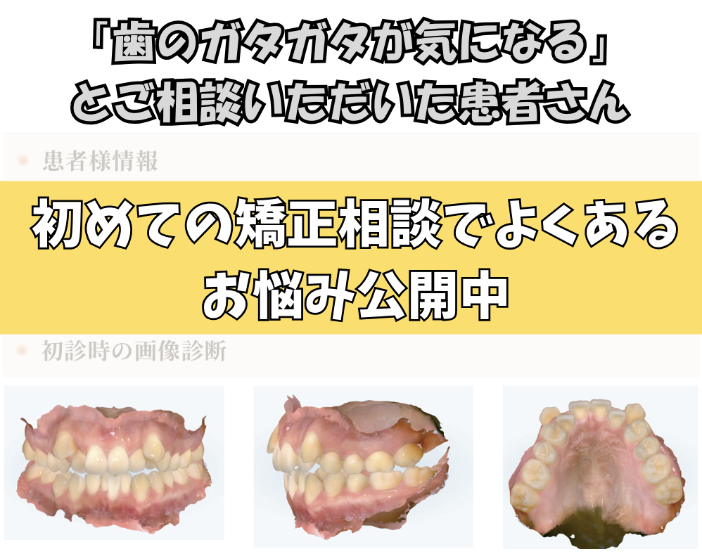 「歯のガタガタが気になる」とご相談いただいたA.Mさん（20歳・女性）のケース