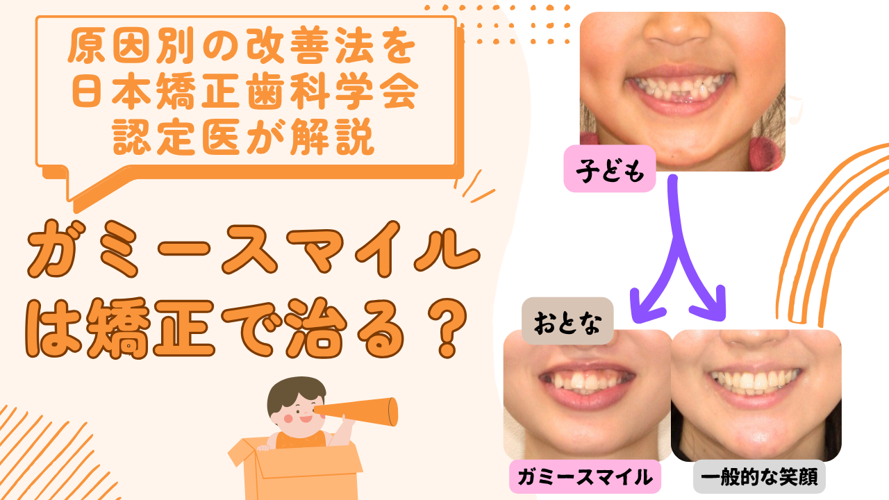 ガミースマイルは矯正で治る？原因別の改善法を日本矯正歯科学会認定医が解説します
