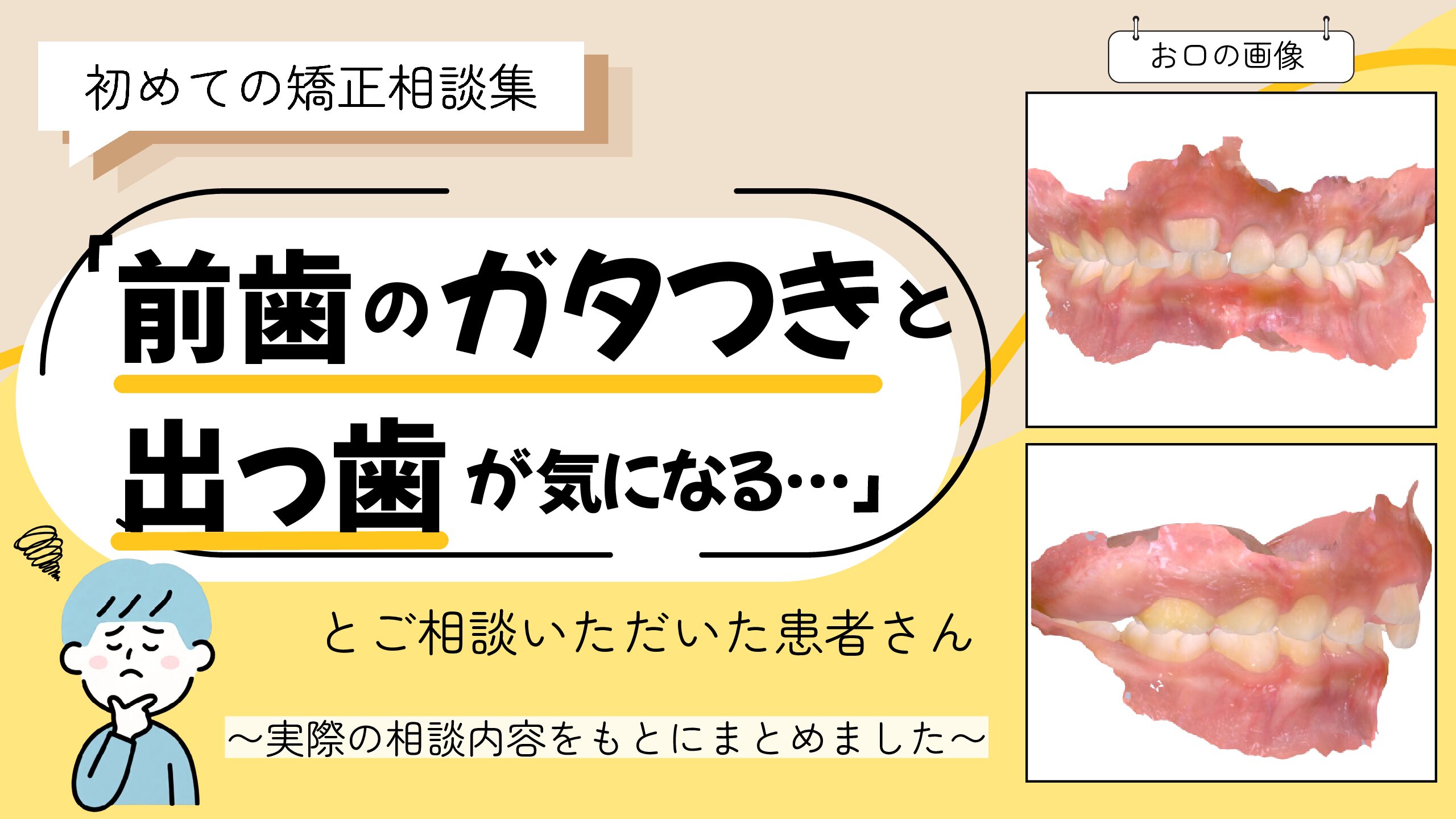 「前歯のガタつきと出っ歯が気になる…」とご相談いただいたR.Kさん（6歳・男の子）のケース