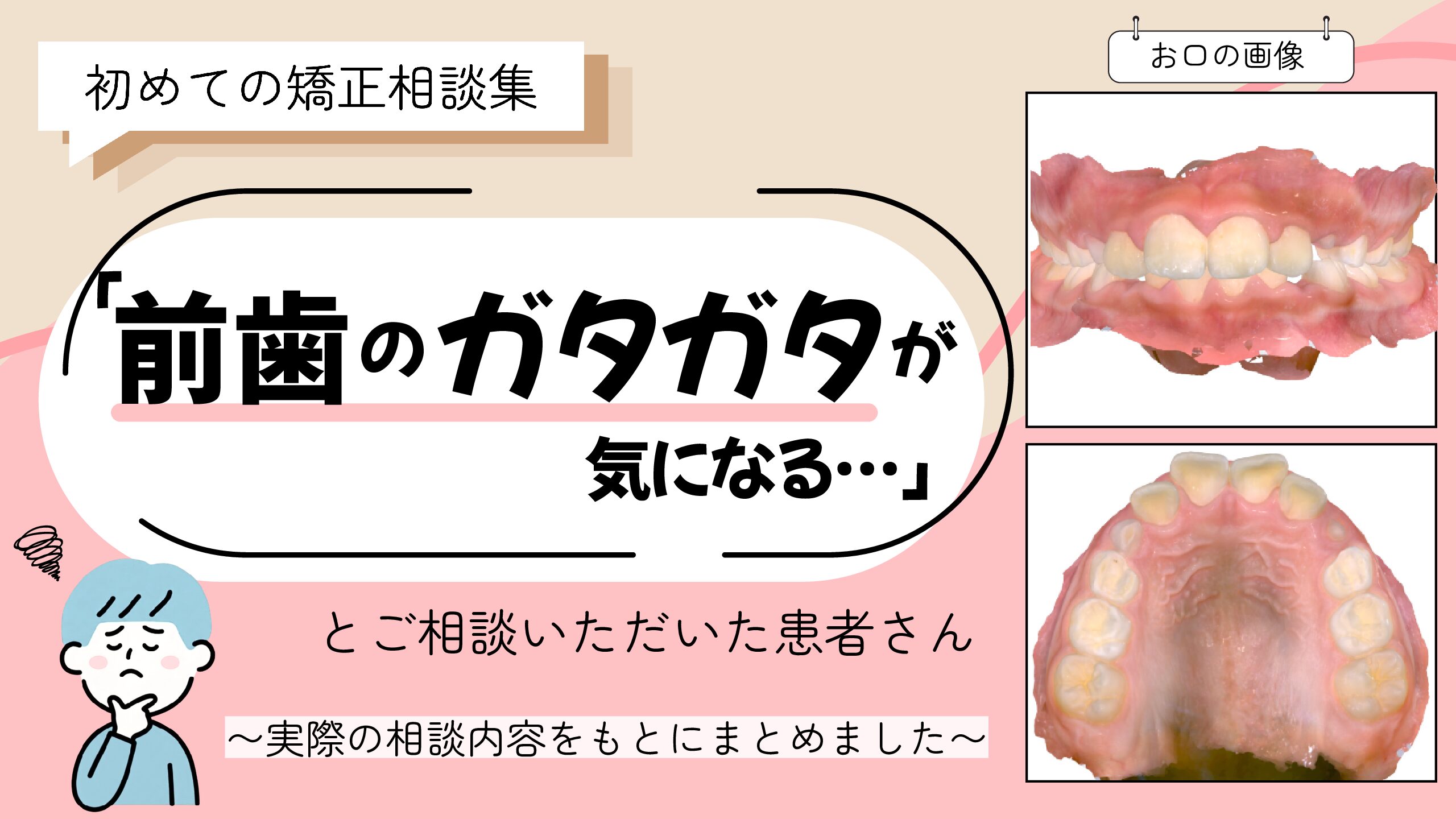 「前歯のガタガタが気になる」とご相談いただいたS.Aさん（9歳・男の子）のケース