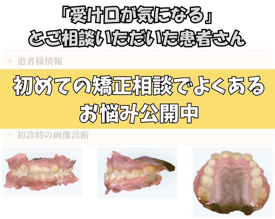 「受け口が気になる」とご相談いただいた Kさん（8歳・女の子）のケース