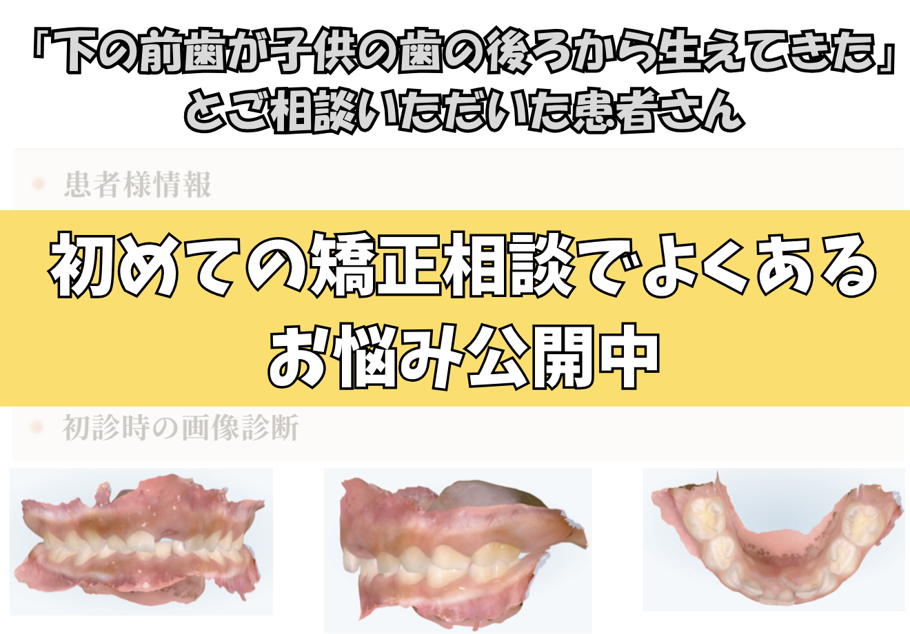 「下の前歯が子供の歯の後ろから生えてきた」とご相談いただいた T.Iさん（6歳・女の子）のケース
