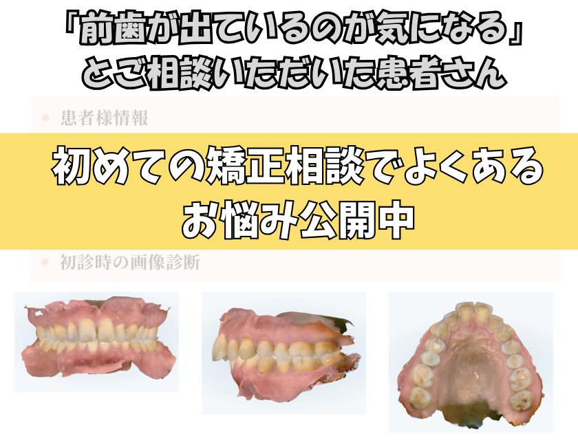 「前歯が出ているのが気になる」とご相談いただいた 　女性のケース　