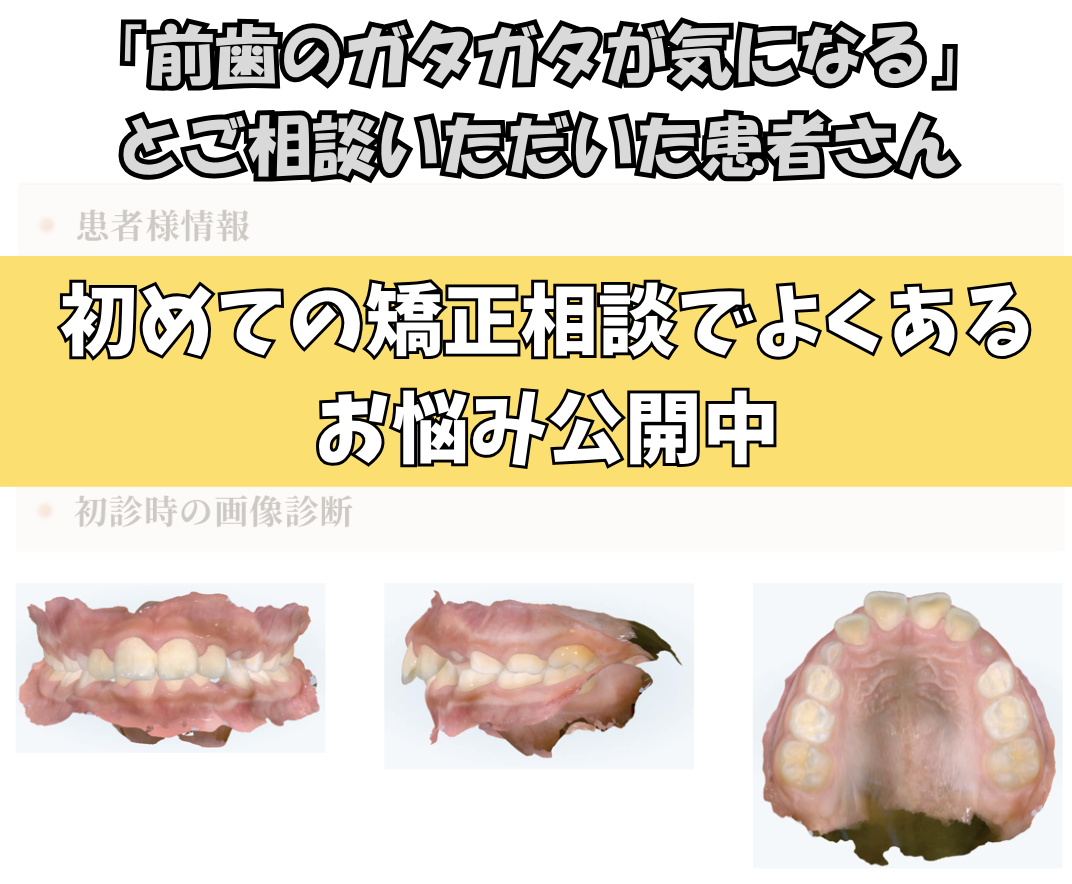 「前歯のガタガタが気になる」とご相談いただいたS.Aさん（9歳・男の子）のケース