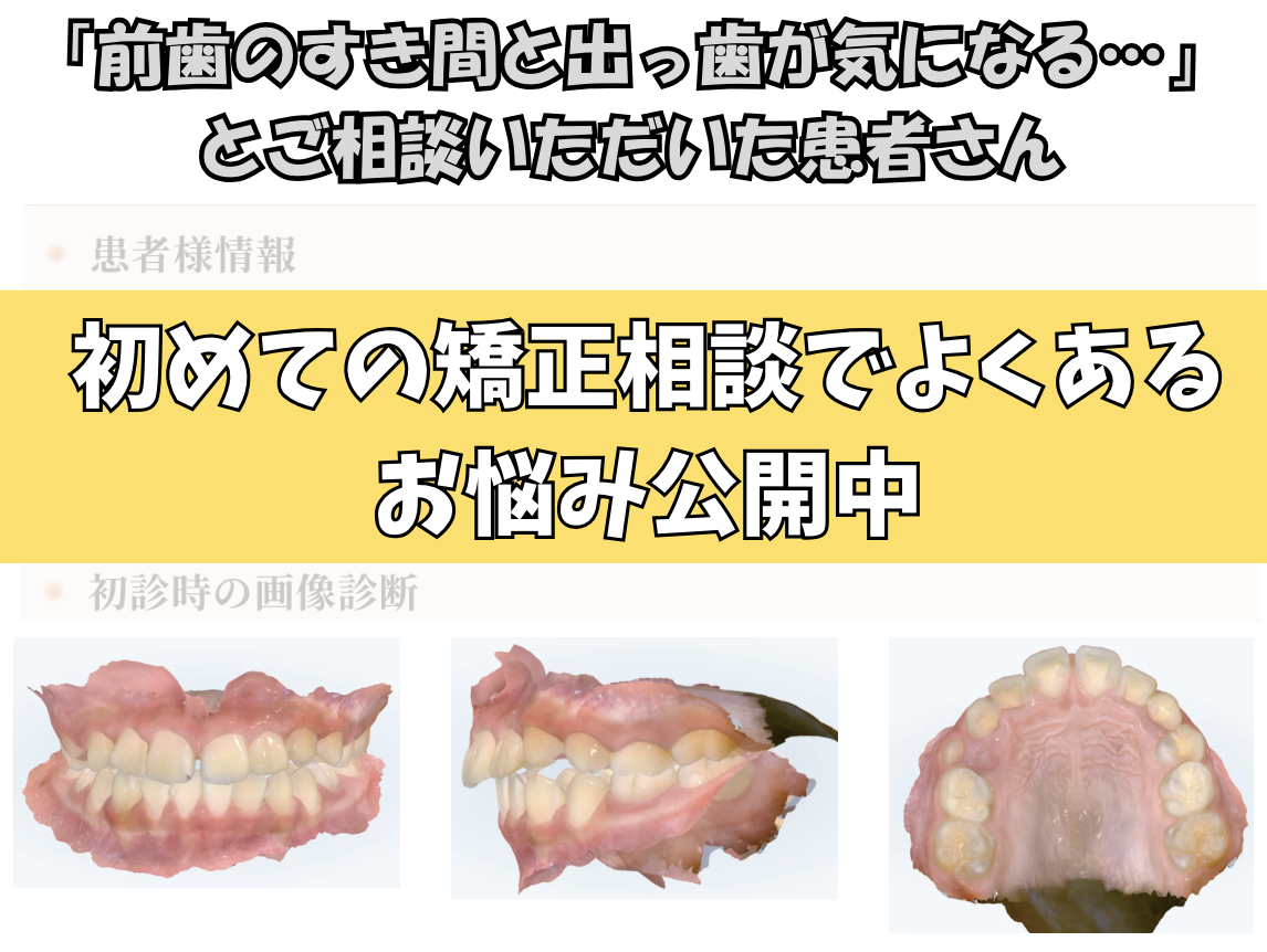 「前歯のすき間と出っ歯が気になる…」とご相談いただいた9歳・女の子のケース