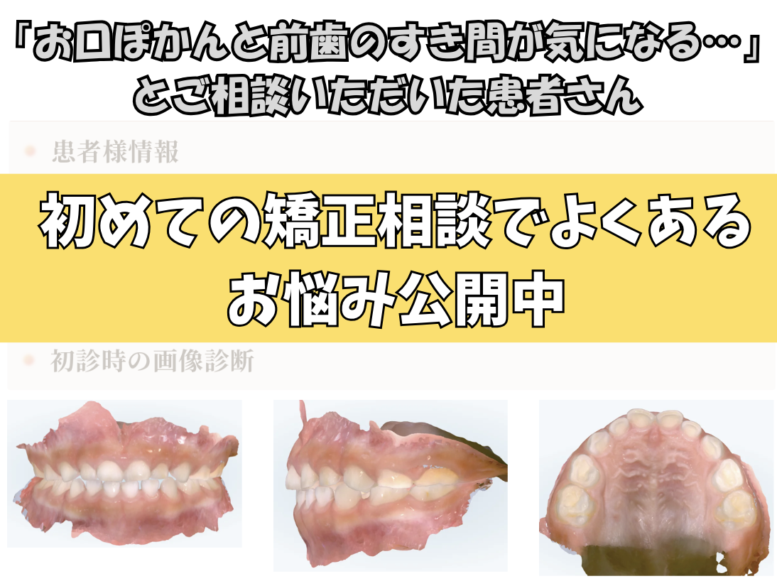 「お口ぽかんと前歯のすき間が気になる…」とご相談いただいたM.Oさん（5歳・男の子）のケース