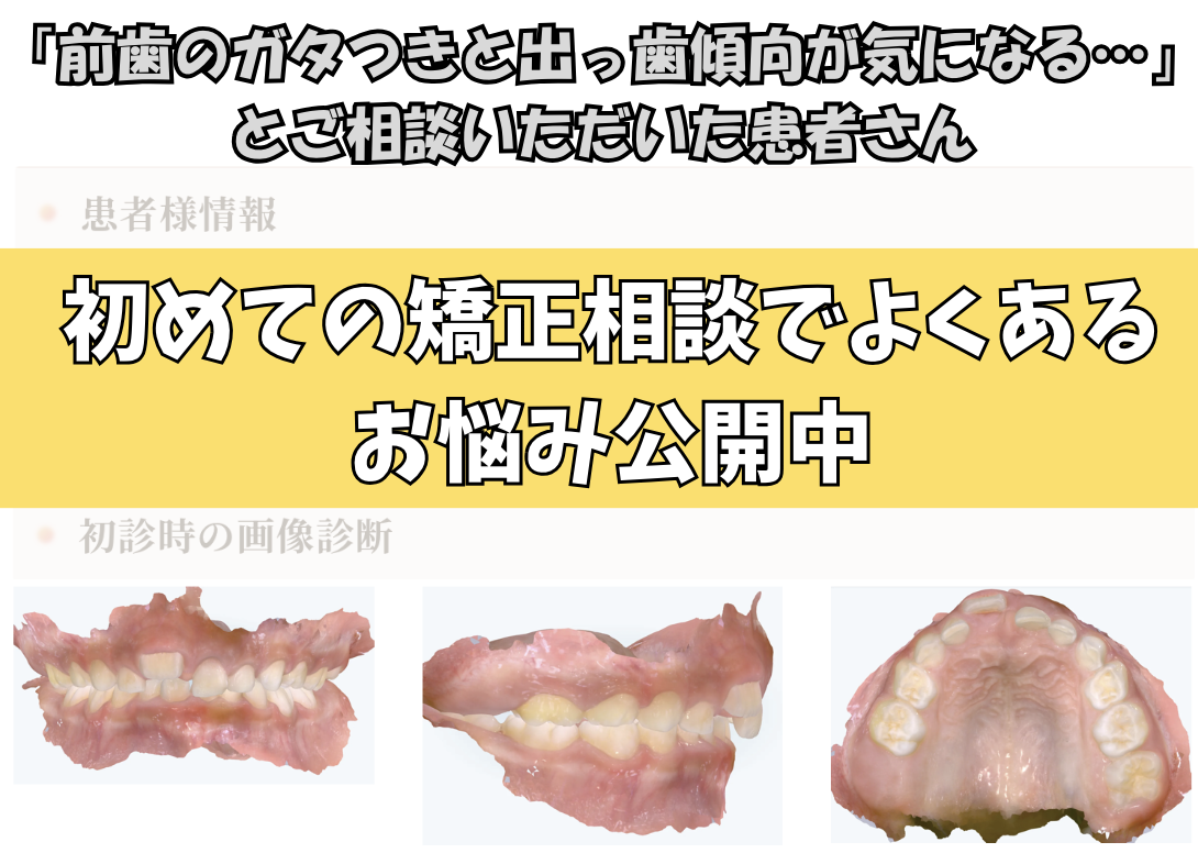 「前歯のガタつきと出っ歯傾向が気になる…」とご相談いただいたR.Kさん（6歳・男の子）のケース
