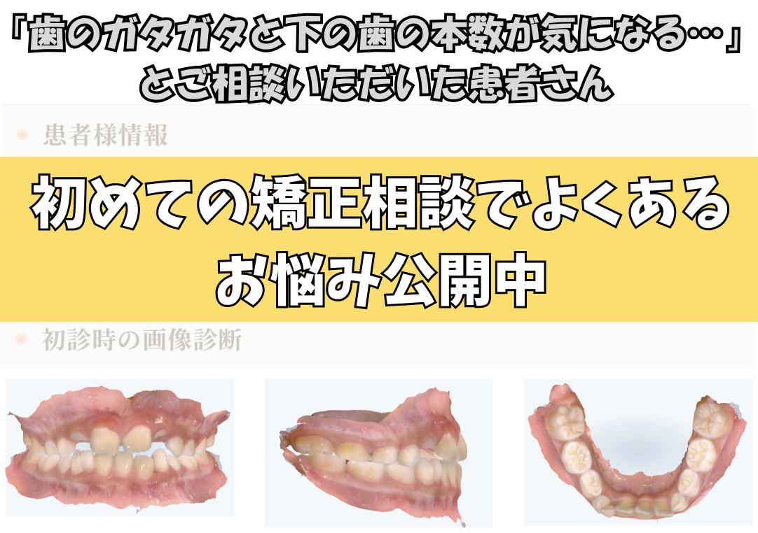 「歯のガタガタと下の歯の本数が気になる…」とご相談いただいたW.Mさん（９歳・女の子）のケース