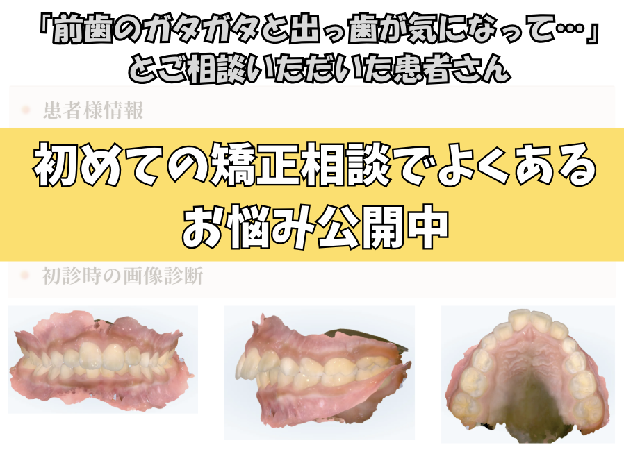 「前歯のガタガタと出っ歯が気になって…」とご相談いただいたS.Nさん（8歳・男の子）のケース