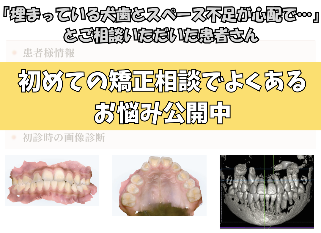 「埋まっている犬歯とスペース不足が心配で…」とご相談いただいたH.Mさん（10歳・女の子）のケース