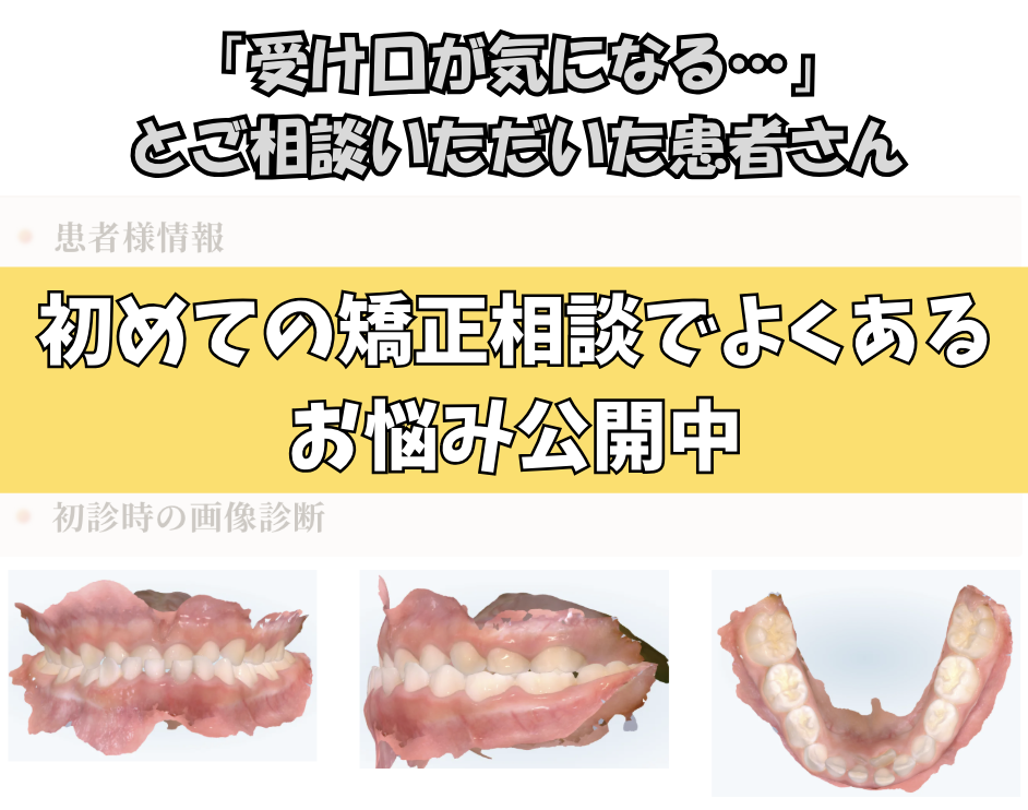 「受け口が気になる…」とご相談いただいたE.Mさん（5歳・女の子）のケース