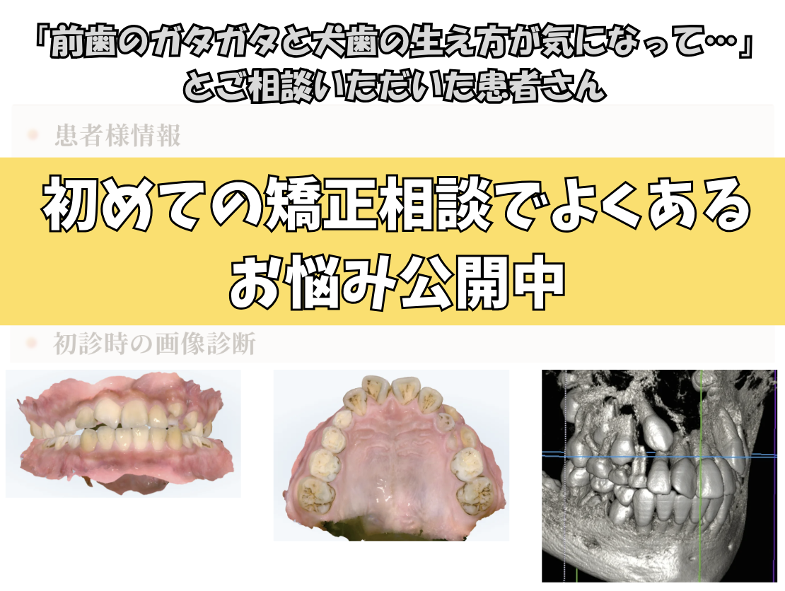 「前歯のガタガタと犬歯の生え方が気になって…」とご相談いただいたK.Nさん（12歳・男の子）のケース