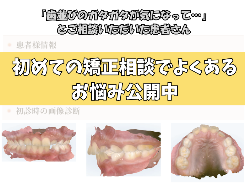 「歯並びのガタガタが気になって…」とご相談いただいた8歳・女の子のケース